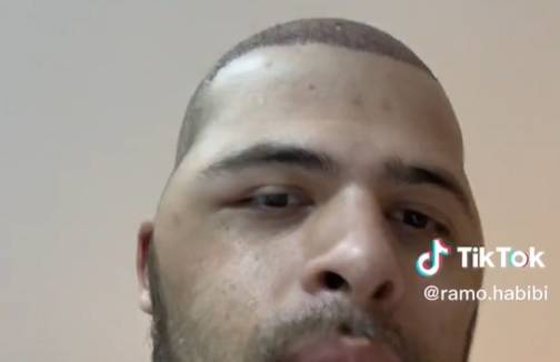 Zabieg medycyny estetycznej w Turcji zakończył się zdeformowaną głową. "To nie jest żaden filtr?" [WIDEO]