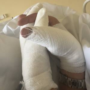 Modelka ma poparzoną całą twarz. Miała koszmarny wypadek. O pomoc apeluje Julia Wieniawa