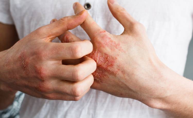 Przyczyny suchej skóry: to może być poważna choroba!