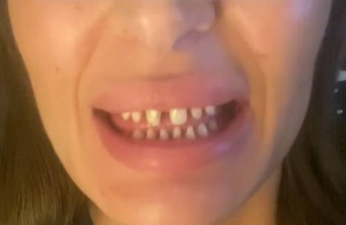 Pojechała zrobić "tureckie zęby". Skończyło się koszmarem: "Wylądowałam w szpitalu, walcząc o życie" [WIDEO]