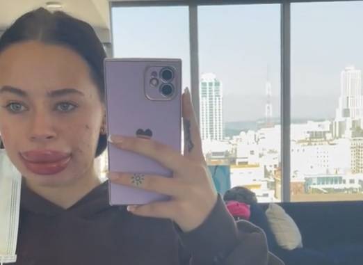 Powiększyła sobie usta za darmo. Szybko pożałowała decyzji: "Najgorsze, co mnie w życiu spotkało" [WIDEO]