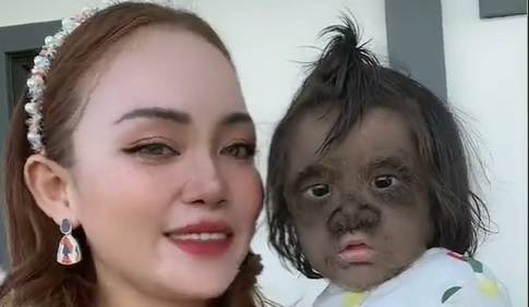 Pokazała światu dziewczynkę z "syndromem wilkołaka". To była ważna lekcja [WIDEO]