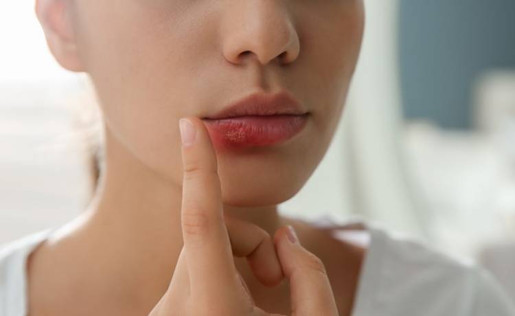 Co na zajady?, fot. Shutterstock