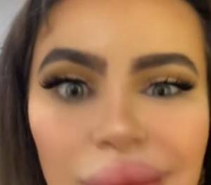 Tiktokerka przeszła zabieg pomniejszenia ust. Problem w tym, że się powiększyły [WIDEO]