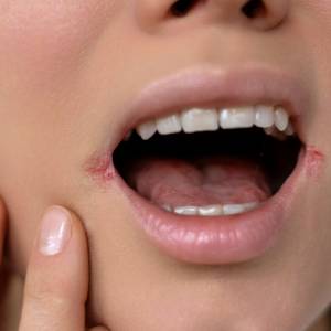 Masz pęknięte kąciki ust? To niedobór tych witamin!