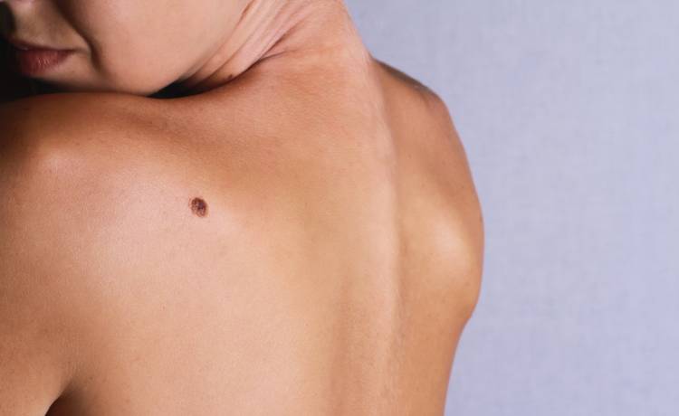 Włos na pieprzyku. Czy można go wyrwać bez obaw o swoje zdrowie?