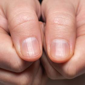 Nie masz lunuli? Medycyna tłumaczy, co to oznacza