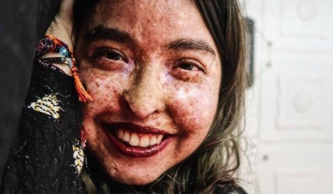 Promienie słoneczne mogą ją zabić. Żyje nocą jak wampir  