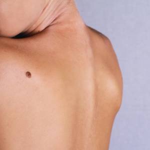 Włos na pieprzyku. Czy można go wyrwać bez obaw o swoje zdrowie?