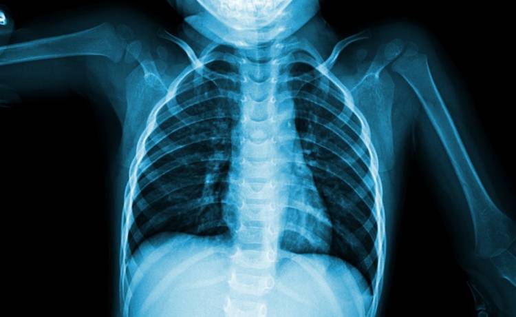 Lekarze zrobili dziecku prześwietlenie i zamarli. To, że niemowlę żyje, to cud. W sercu miało igłę!