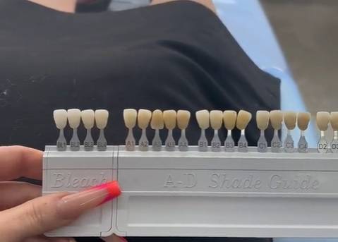 "Nie wierzcie we wszystko, co przeczytacie na temat zabiegów w Turcji". Tiktokerka zabiera głos po zrobieniu tureckich zębów [WIDEO]