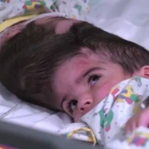 Bliźniaczki syjamskie rozdzielone po trwającej 50 godzin operacji