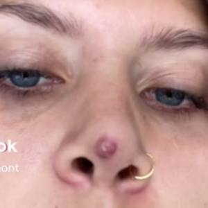 Po operacji plastycznej na nosie pojawił się guz. Ma już dwa lata [WIDEO]