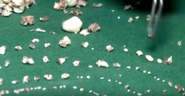 Chłopczyk miał w szczęce... 526 zębów! 7-latek jest już po zabiegu