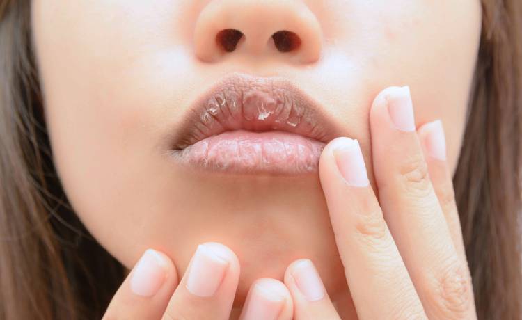 Popękane i suche usta w zimie. Jak zregenerować uszkodzone wargi?