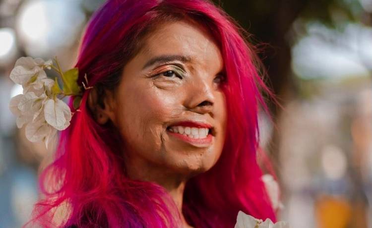 Kiedy miała dwa miesiące, ojciec oblał ją kwasem. Dziś Anmol Rodriguez robi karierę modelki!