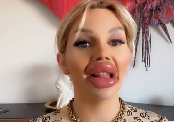 Zwariowała na punkcie operacji plastycznych. Jej usta utrudniają jej normalne funkcjonowanie 