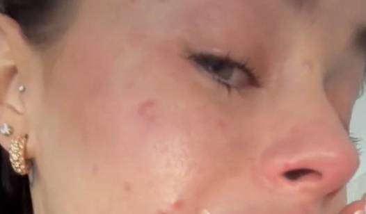 Powiększyła sobie usta. Prawie eksplodowały. "Wyglądam przerażająco" [WIDEO]