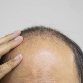 Przełom w walce z łysieniem! Japońscy naukowcy stworzyli w laboratorium w pełni funkcjonalny mieszek włosowy