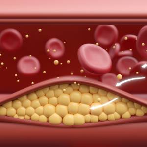 Tak obniżysz poziom cholesterolu. Pamiętaj o tych 3 rzeczach!