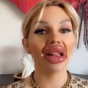 Zwariowała na punkcie operacji plastycznych. Jej usta utrudniają jej normalne funkcjonowanie 