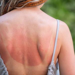 Latem nie ignoruj tych trzech objawów na skórze. Jeśli je zauważysz – idź do lekarza!