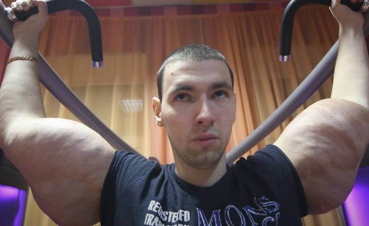 Jego bicepsy eksplodowały przez wstrzykiwanie oleju. To go nie zniechęciło [FOTO]