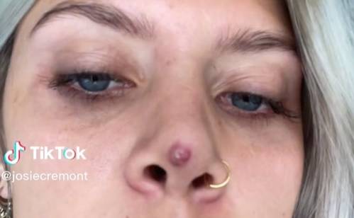 Po operacji plastycznej na nosie pojawił się guz. Ma już dwa lata [WIDEO]