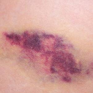 Wielkość jej źrenic zaczęła się zmieniać, wszędzie czuła gaz, a skóra zrobiła się niebieskawa. Ostrzega innych przed rzadką chorobą [WIDEO]