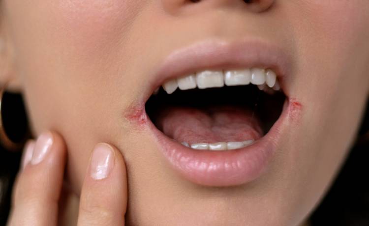 Jakiej witaminy brakuje, kiedy pękają kąciki ust?, fot. Shutterstock