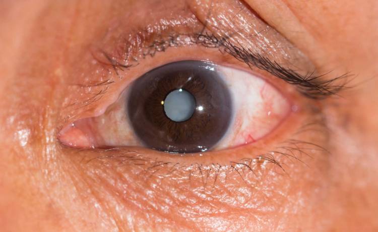 Operacja zaćmy – co musisz wiedzieć i o czym pamiętać po zabiegu?