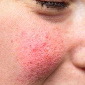 Czerwona plama na twarzy? Może chodzić o poziom wit. B3