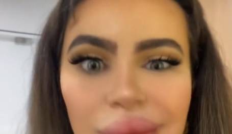 Tiktokerka przeszła zabieg pomniejszenia ust. Problem w tym, że się powiększyły [WIDEO]